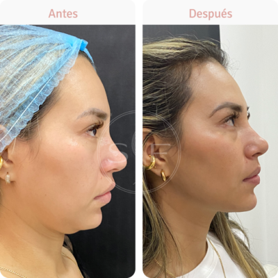 Antes-y-despues-Bioestimuladores