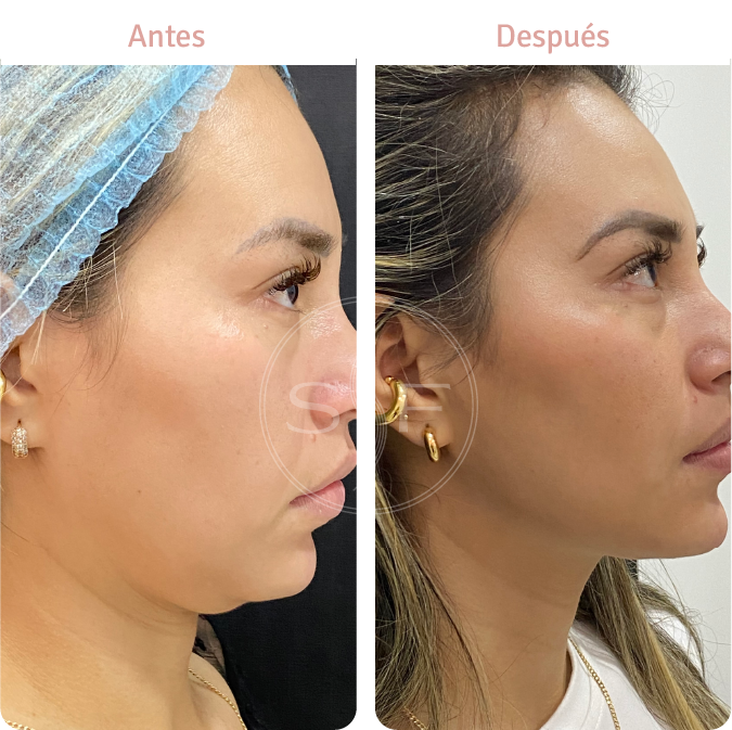ANTES 1