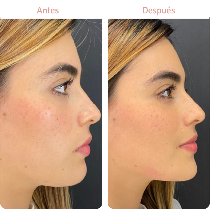 ANTES 2